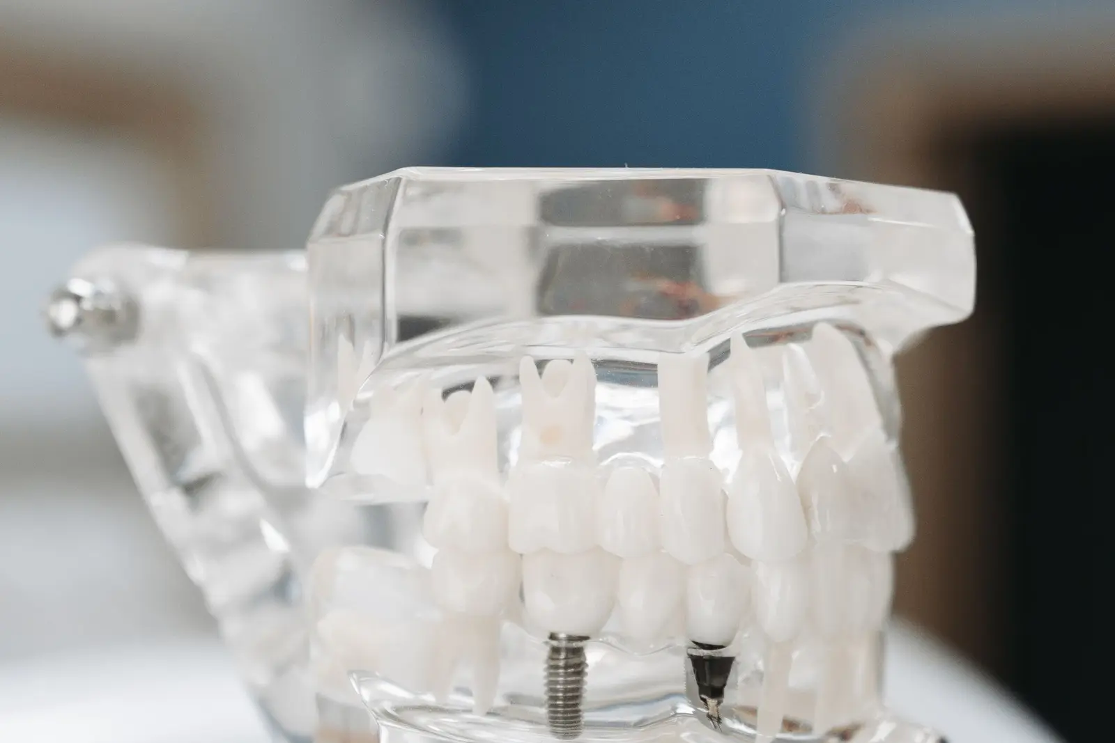 Immediate Implants After Extraction and Immediate Loading