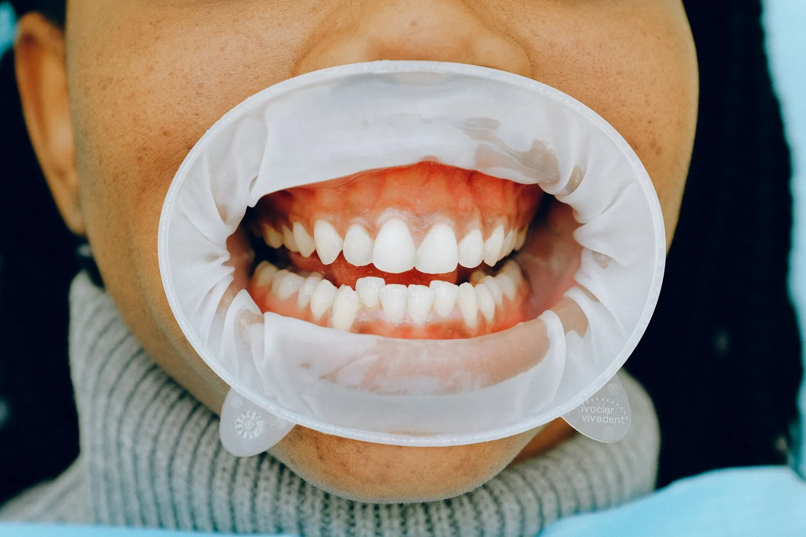Diş Eti Gülümsemesi (Gummy Smile) Nedir?