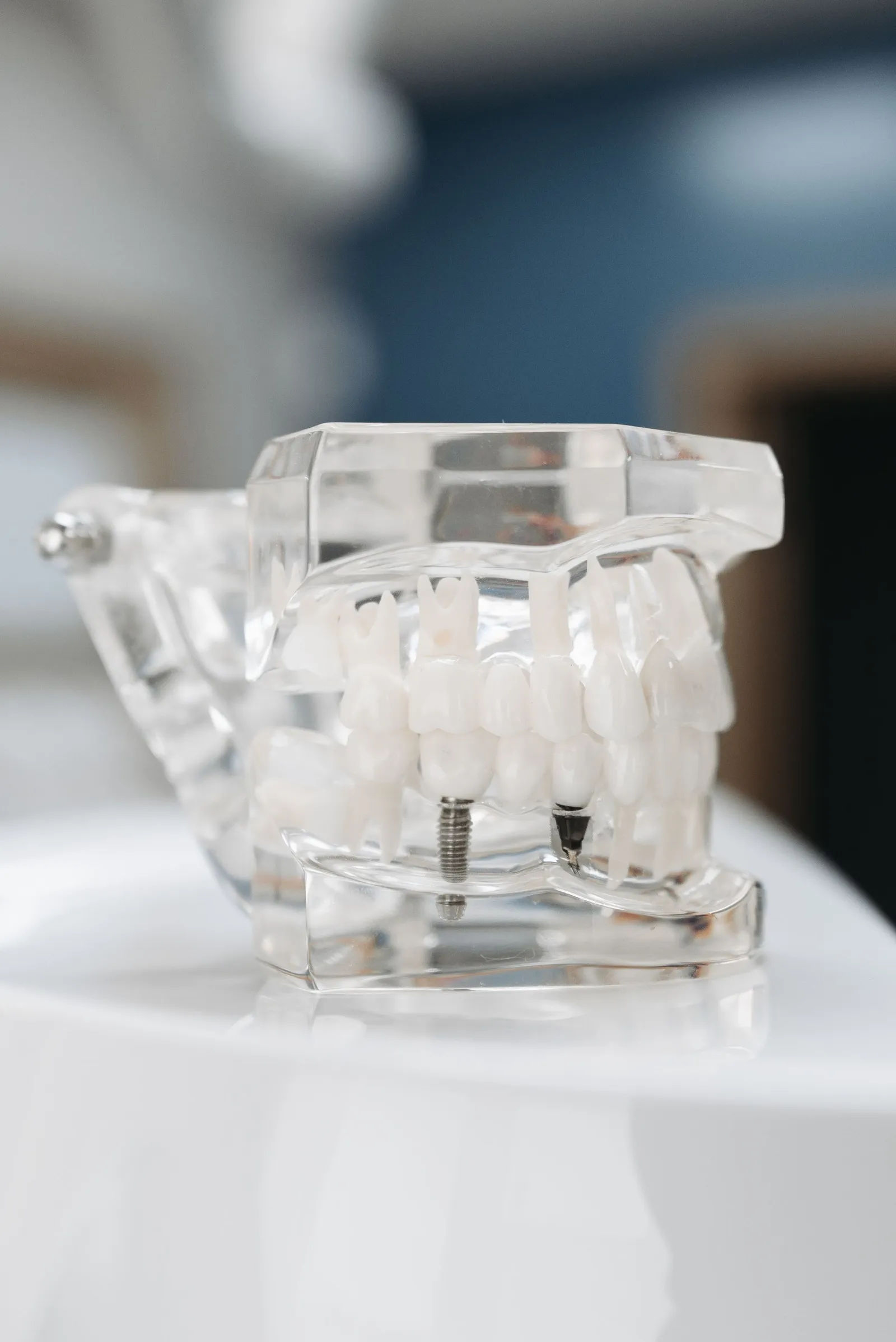 Dental Implant Treatment Guide: From Assessment to Long-Term Care