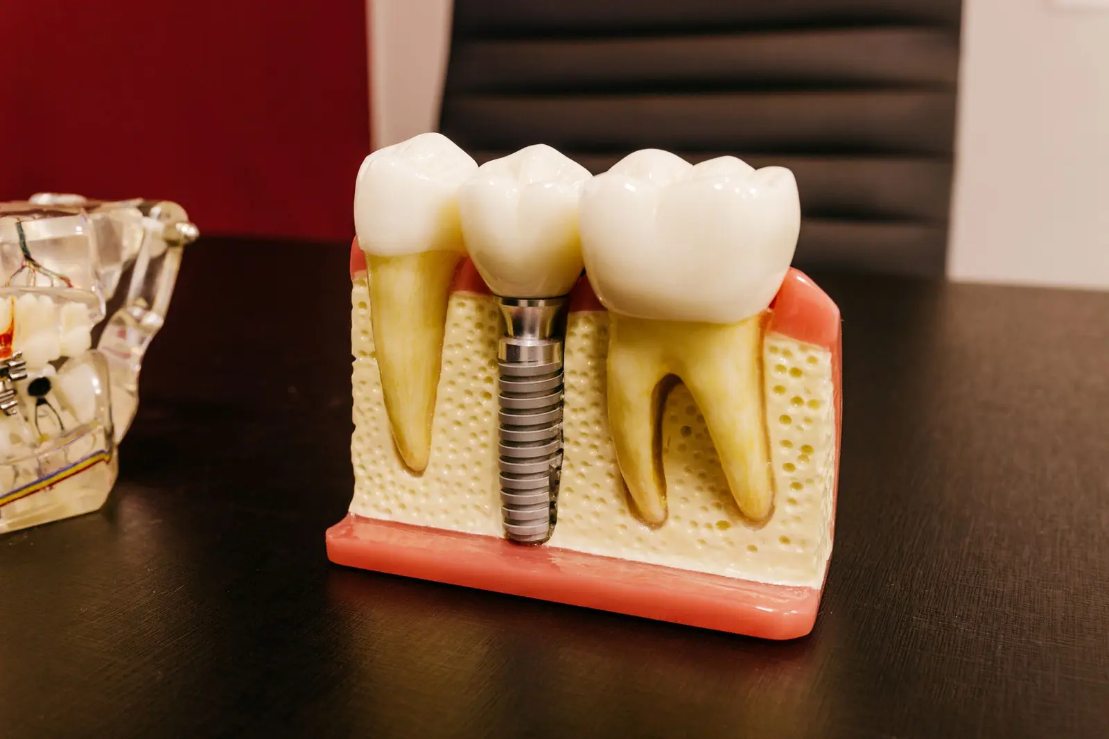 Implant-Supported Fixed Prosthesis for Full-Arch Tooth Loss